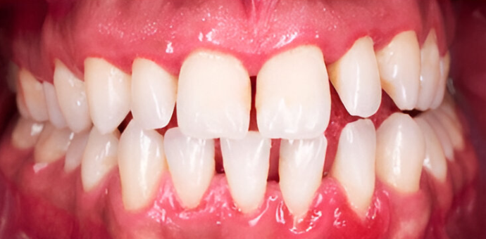 Dental Clinic Dental spacing
