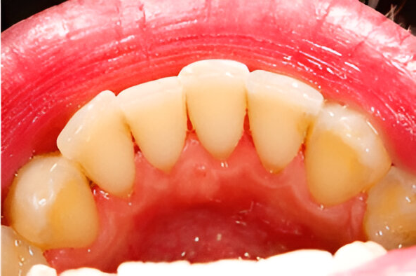 Dental clinic Removal of teeth tartar