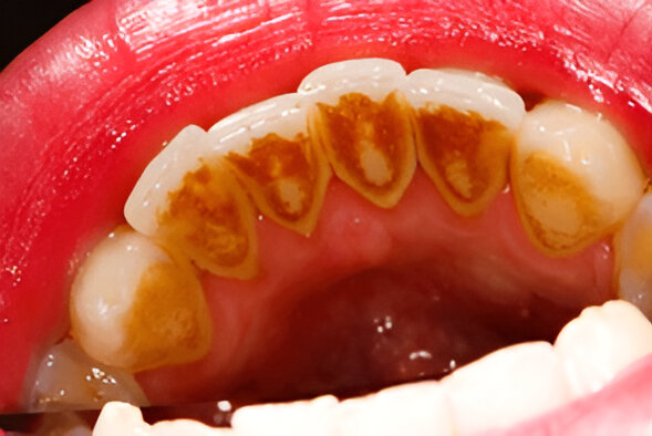 Dental clinic Dental plaque