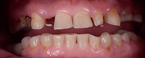 Dental center Chipped tooth