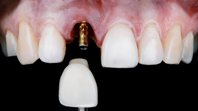 Dental Implant