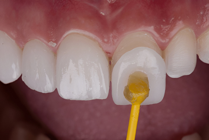 Dental veneer