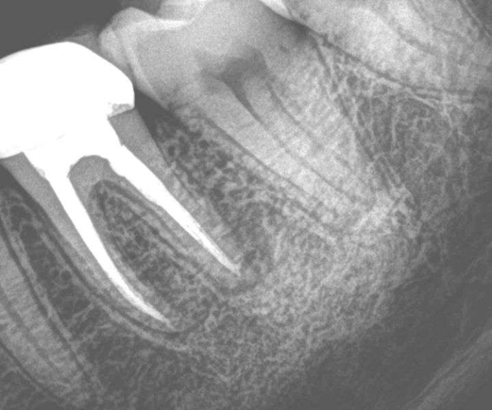 Dental Root canal treatment