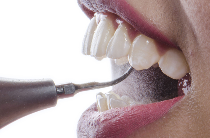 Dental Scaling