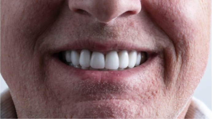 Dental center Types of Dental Implant