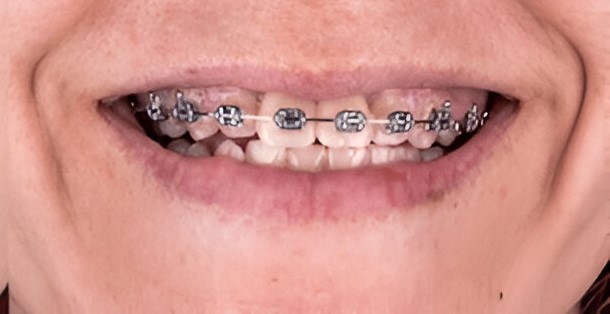 Dental Center Orthodontic Treatments