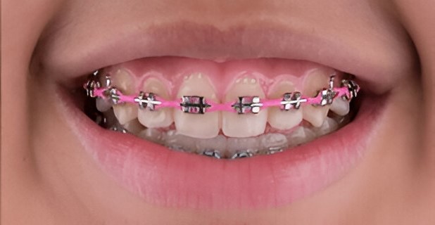 Dental Braces