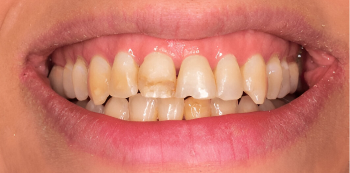 Dental Clinic Dental Veneers