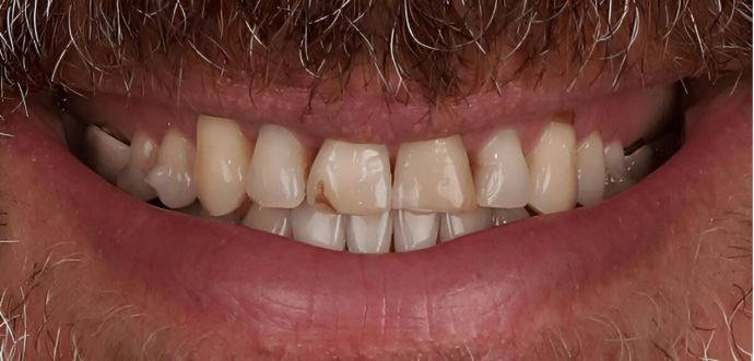 Dental Clinic Dental cracks