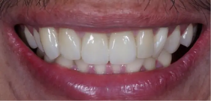Dental Center Dental Bridge