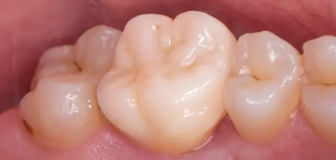 Dental Center Zirconia Dental Crown