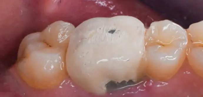 Dental Center Porcelain Dental Crown