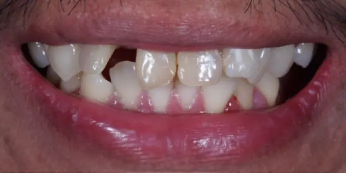 Dental clinic Dental Crown