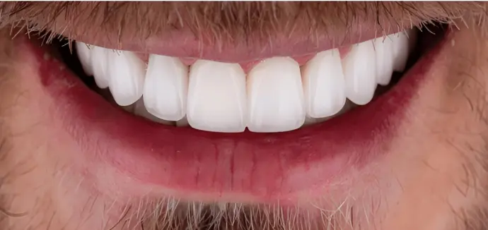 Dental Crown Perfect Teeth