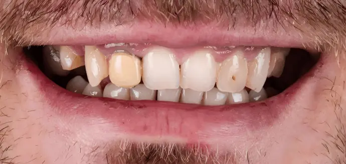 Dental Clinic Dental crown Sensitivity