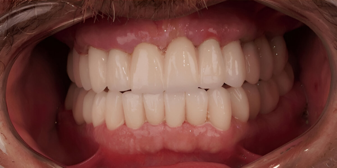 Dental clinic Dental Implant price