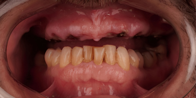 Dental Center Best Dental Implant