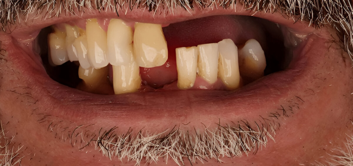 Dental Clinic Lost teeth