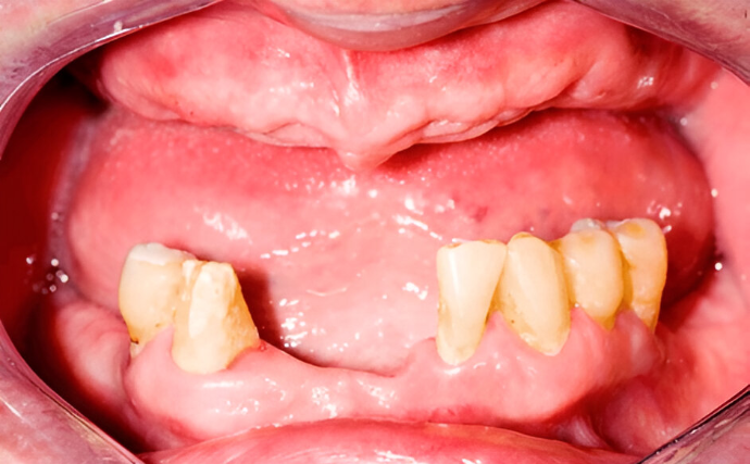 Dental Clinic Restoring lost teeth