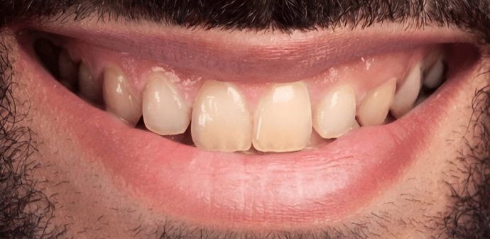 Dental Center Ways to bleach teeth